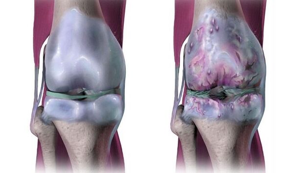 Здоровий колінний суглоб і вражений артрозом