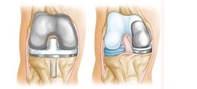 ендопротезування при артрозі колінного суглоба