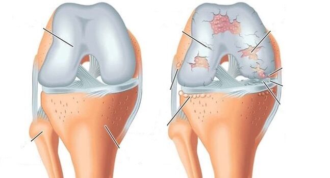 здоровий суглоб і артроз колінного суглоба