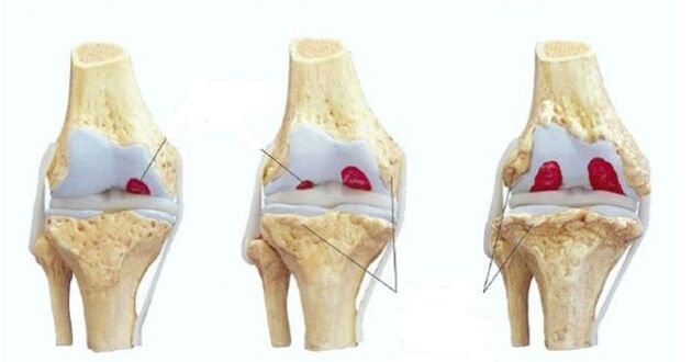 стадії розвитку артрозу колінного суглоба