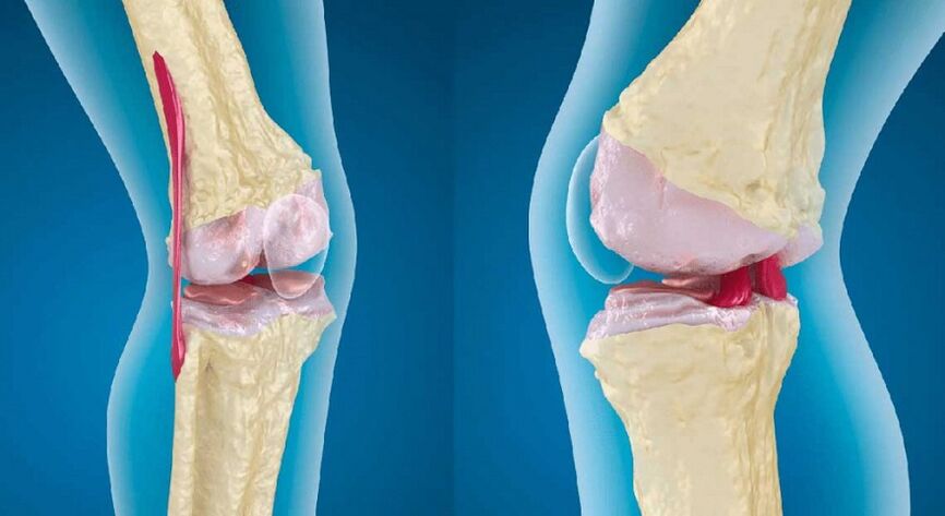 здоровий суглоб і артроз колінного суглоба