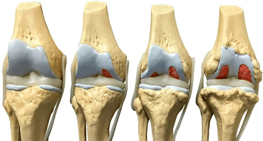 ураження колінного суглоба на різних стадіях розвитку артрозу