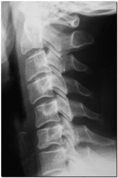 рентгенологічний знімок шийного відділу позвночніка