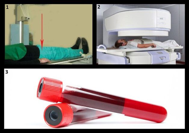 Методи діагностики коксартрозу - рентген і МРТ кульшового суглоба, аналіз крові