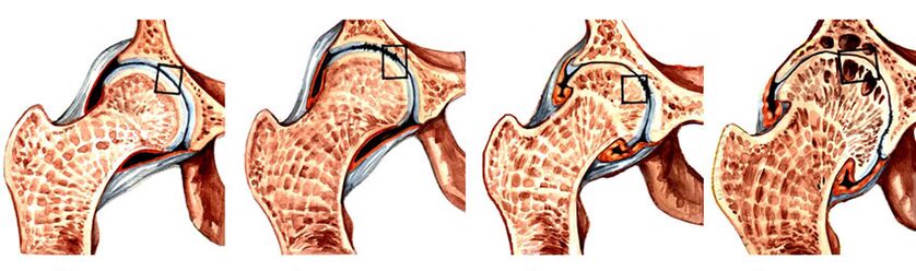 Ступеня розвитку артрозу тазостегнового суглоба