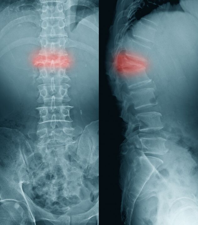 діагностика болю у спині
