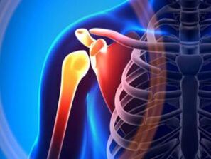 Запалений плечовий суглоб при артрозі – хронічному захворюванні опорно-рухового апарату