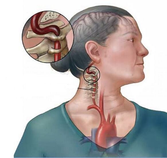 синдром хребетної артерії при шийному остеохондрозі